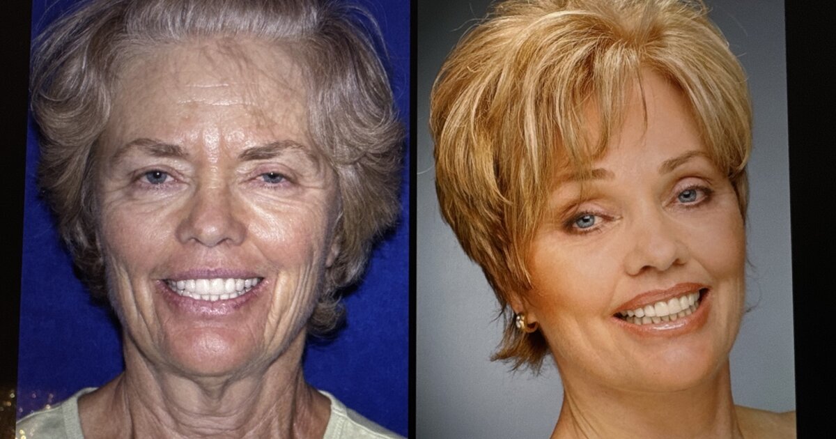 Side-by-side photographs of a BellaNova facelift patient. Individual results vary.