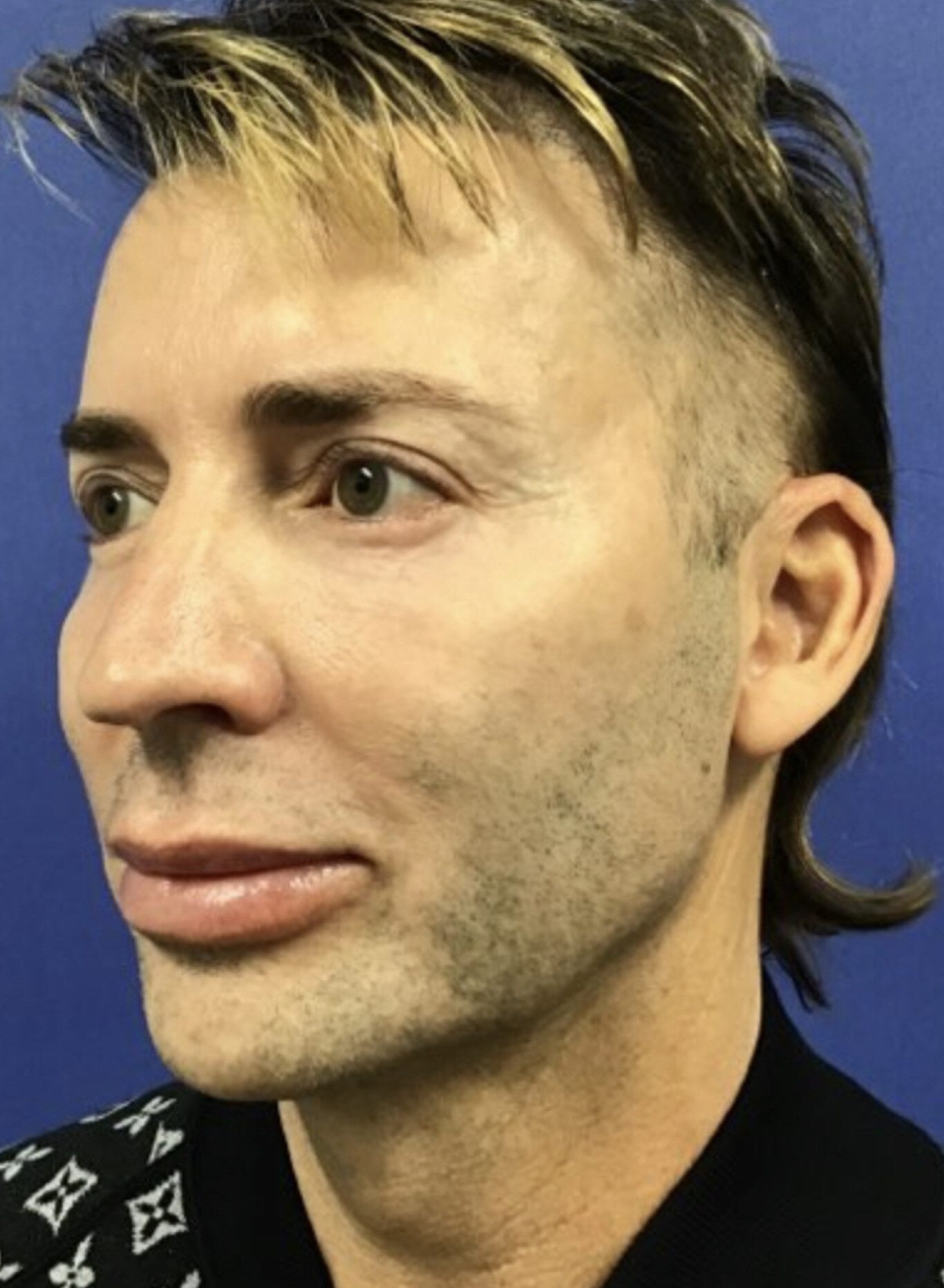 Before custom jawline implant male three-quarter view photograph, West Palm Beach area patient