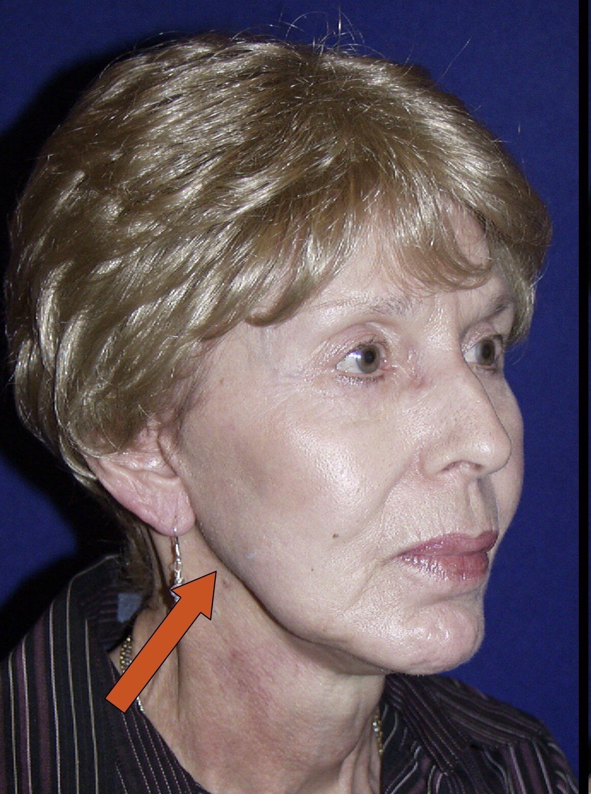 Before custom jawline implant female oblique view photograph, West Palm Beach area patient
