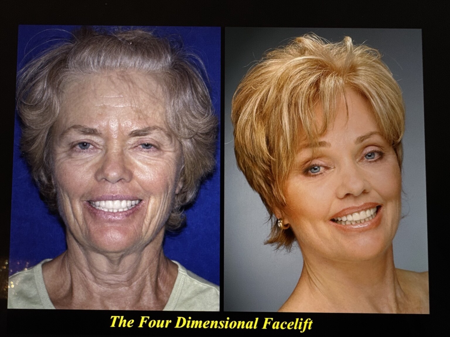 Four-dimensional facelift before and after front-view photograph, female patient, West Palm Beach area