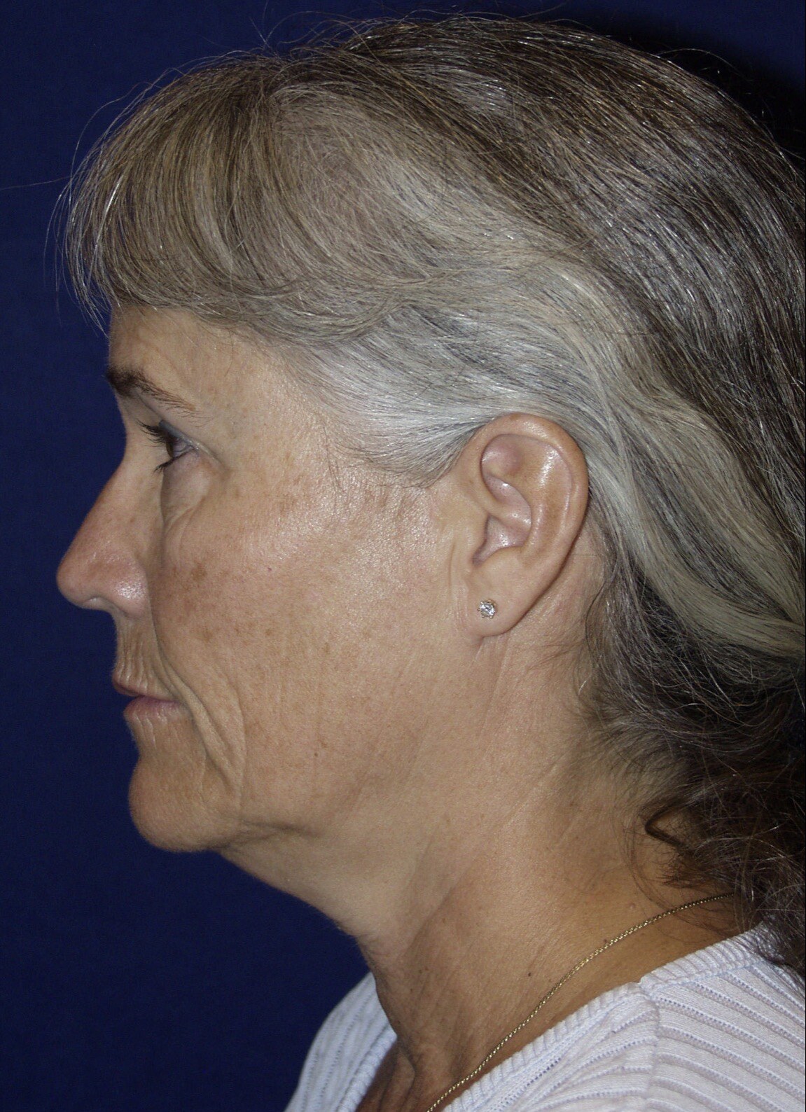 Before 4D facelift left profile photograph, West Palm Beach area patient