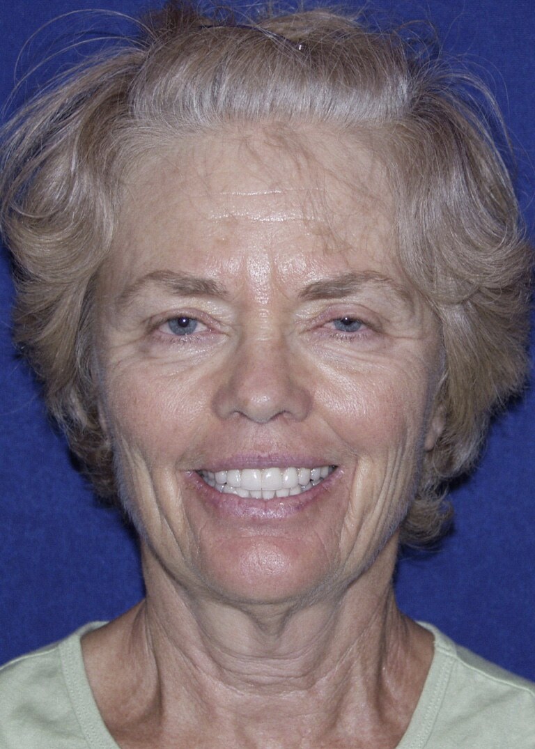 Before 4D facelift front view photograph, West Palm Beach area patient
