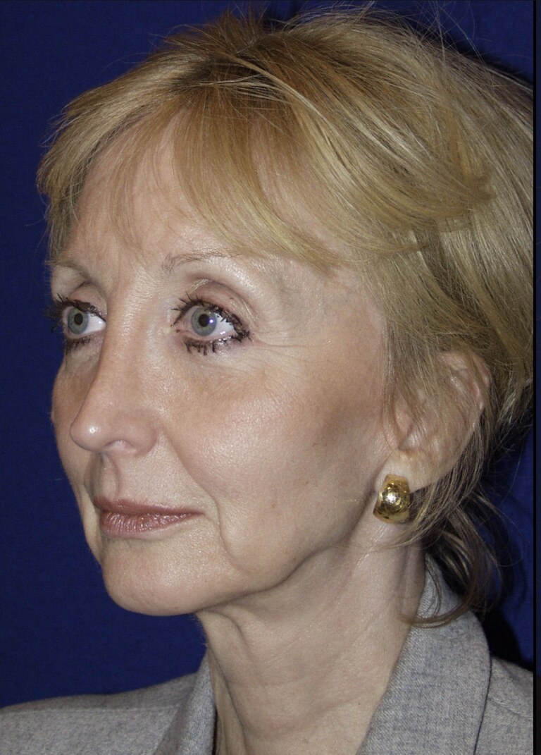 Before 4D facelift three-quarter view photograph, West Palm Beach area patient