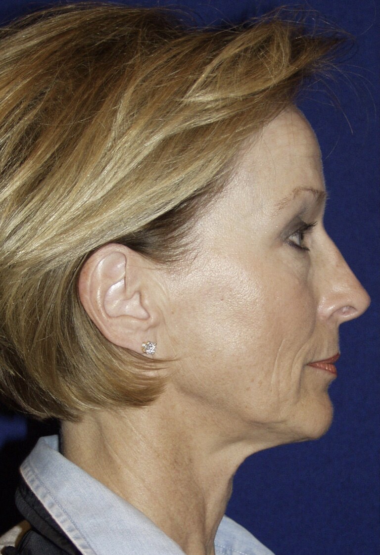 Before 4D facelift side profile photograph, West Palm Beach area patient
