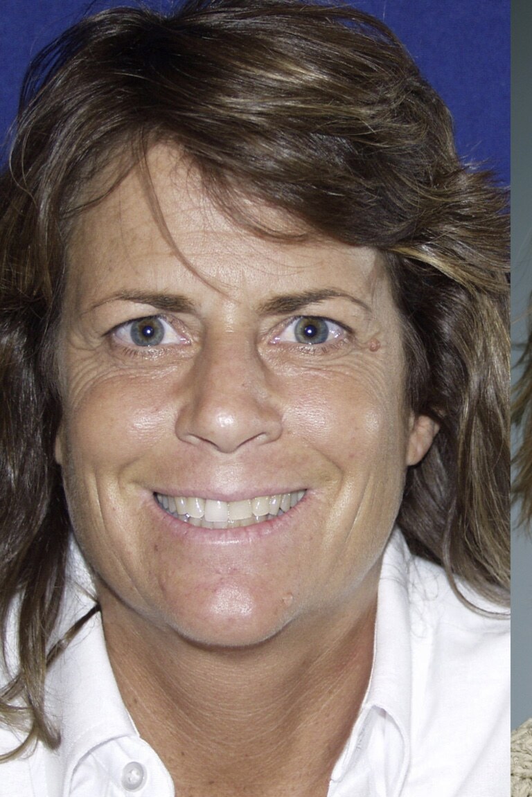 Before 4D facelift front view photograph, West Palm Beach area patient