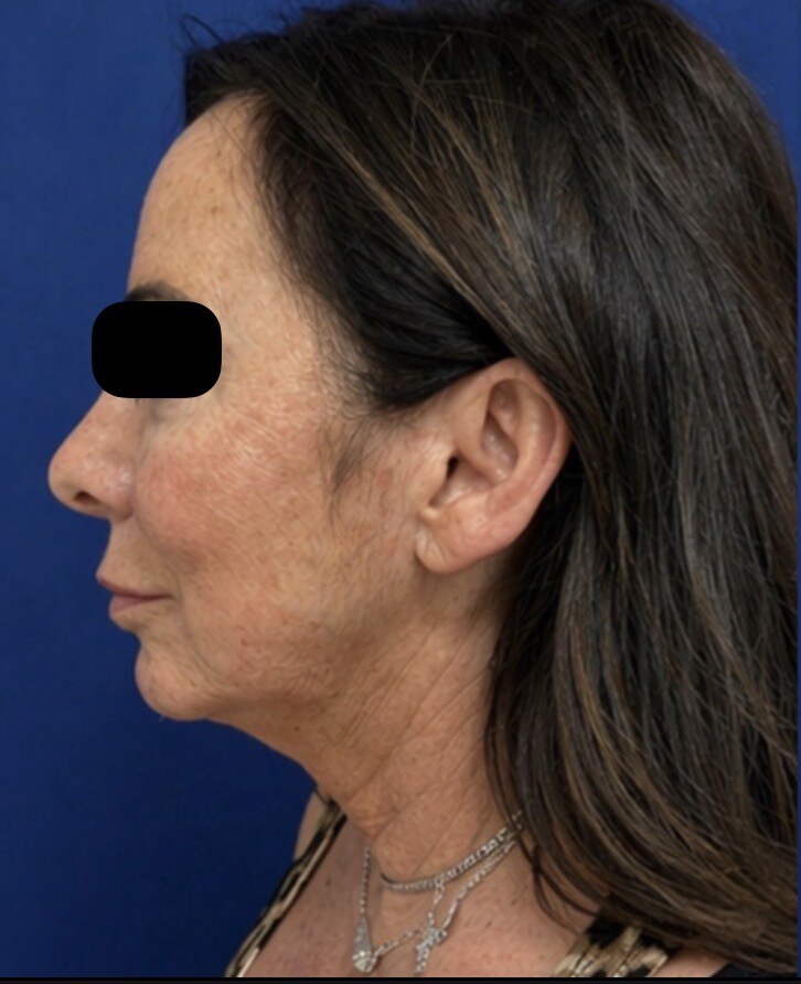 Before 4D facelift side profile photograph, West Palm Beach area patient