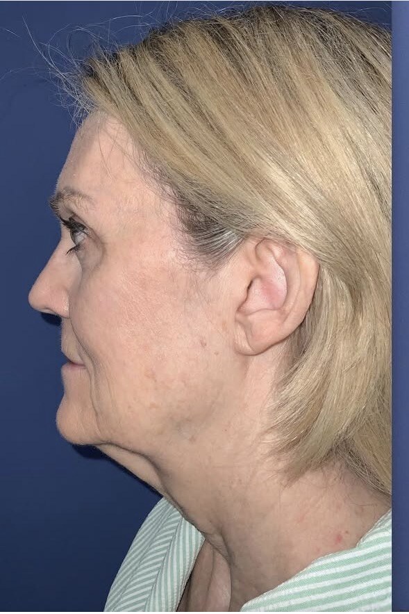 Before 4D facelift side profile photograph, West Palm Beach area patient