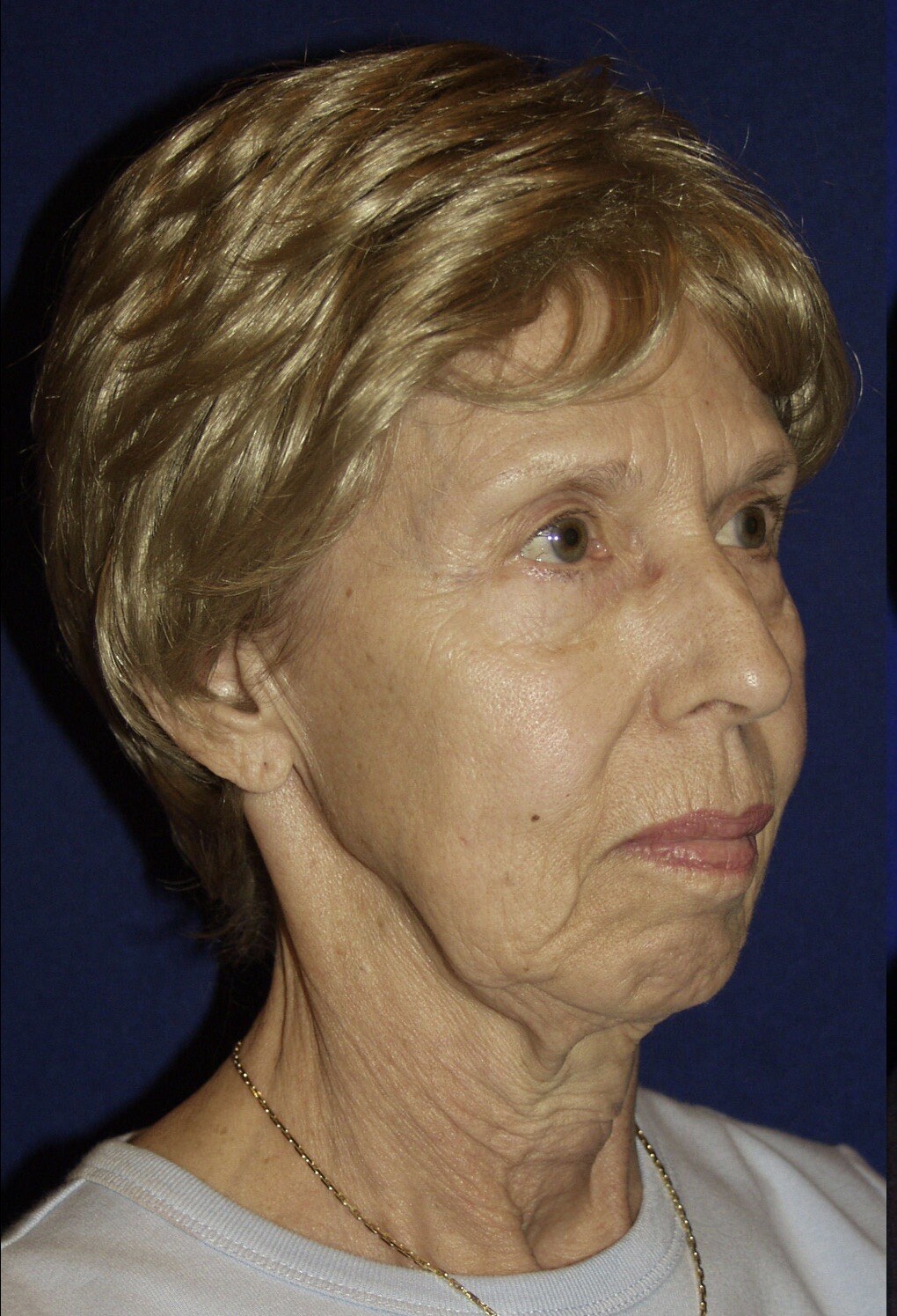 Before 4D facelift oblique view photograph, West Palm Beach area patient