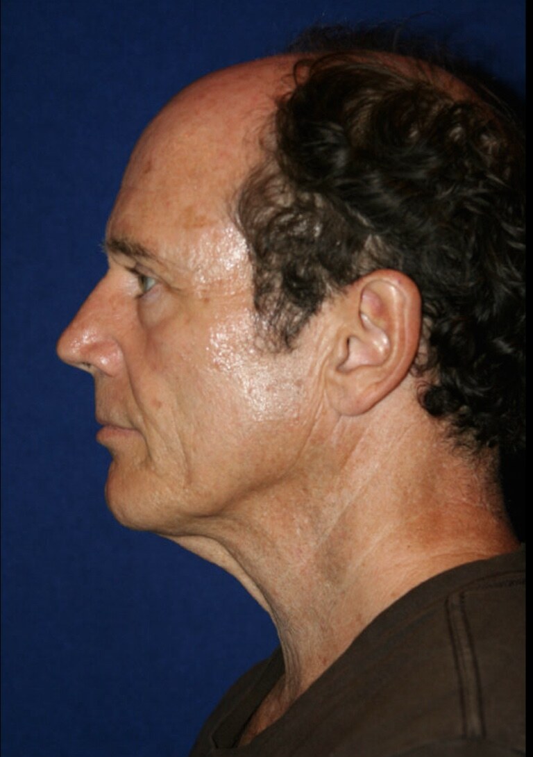Before 4D facelift male side profile photograph, West Palm Beach area patient