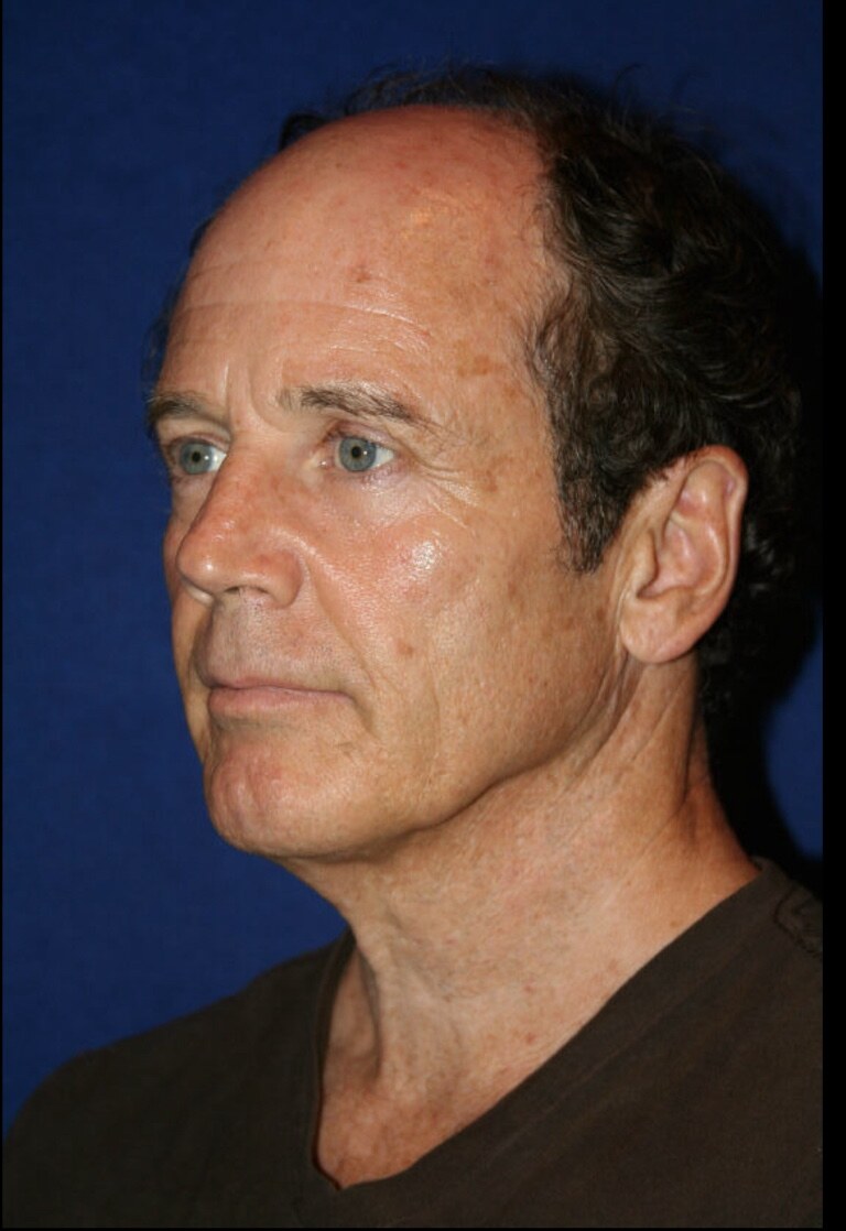 Before 4D facelift male three-quarter view photograph, West Palm Beach area patient