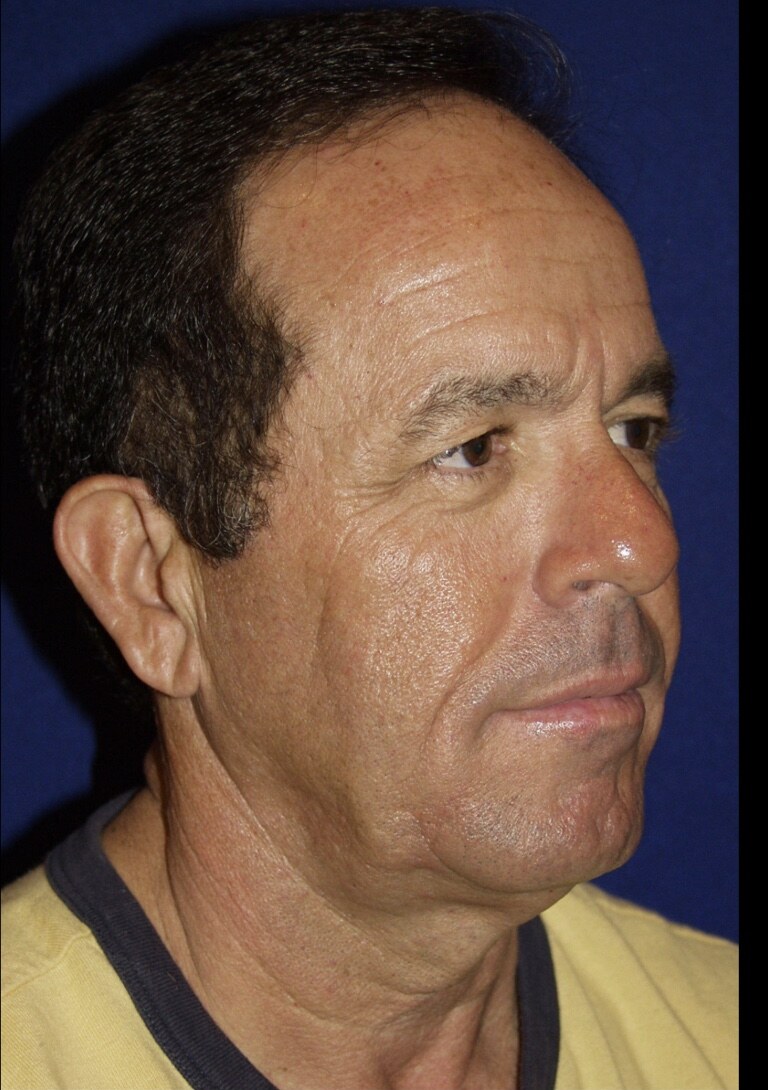 Before 4D facelift male front view photograph, West Palm Beach area patient