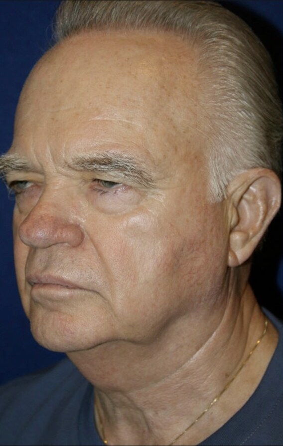 Before 4D facelift male oblique view photograph, West Palm Beach area patient