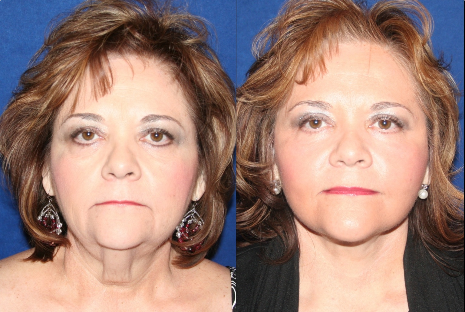 66-year-old woman before, left, and 3 months after combined facial rejuvenation, right.