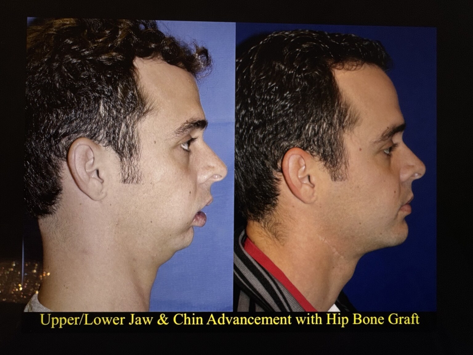Before and after upper and lower jaw surgery with chin advancement and hip bone graft, side profile