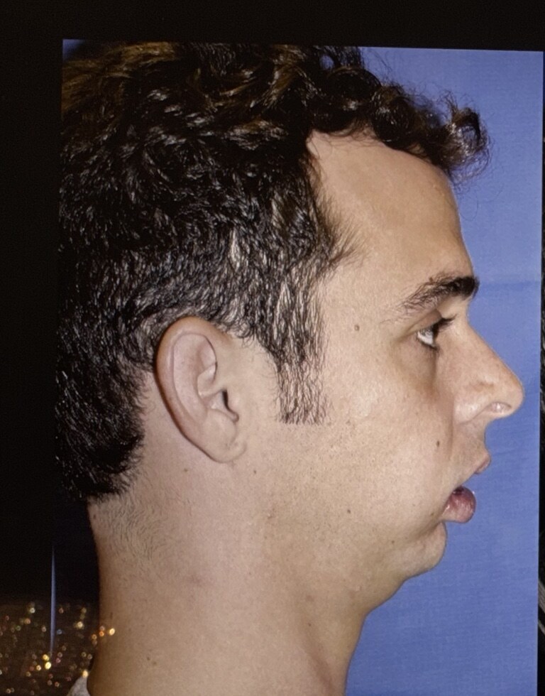 Before jaw surgery side profile photograph, West Palm Beach area patient