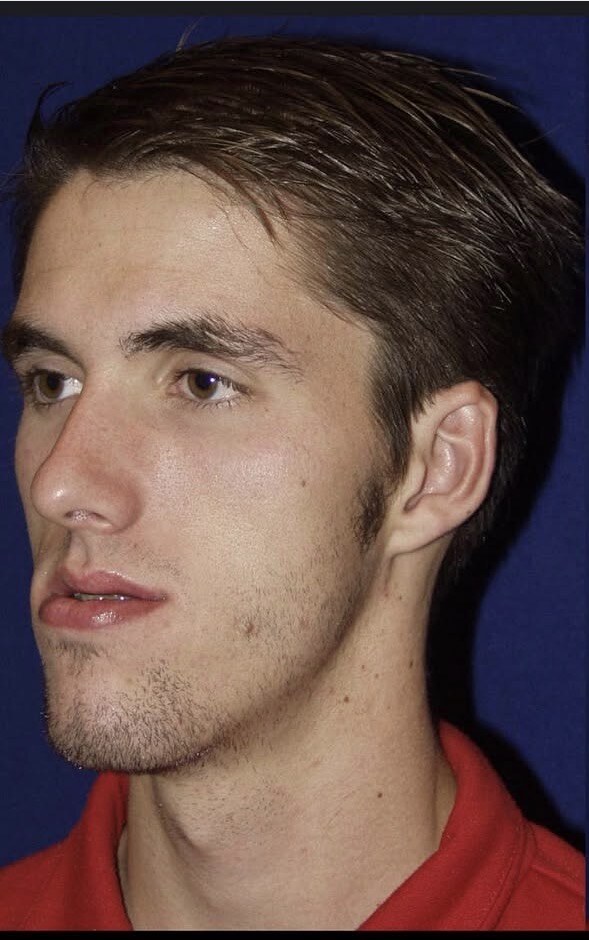 Before jaw surgery three-quarter view photograph, West Palm Beach area patient