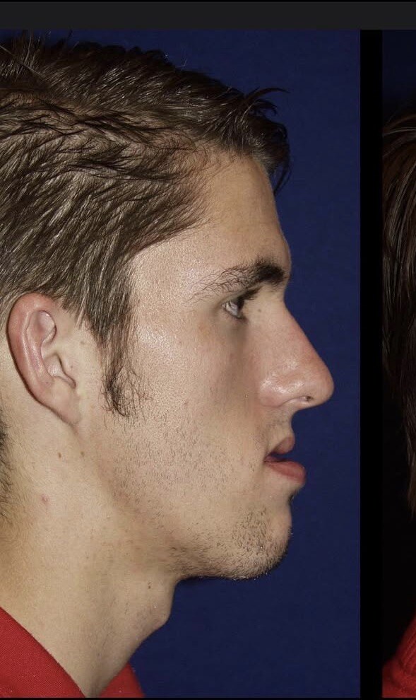Before jaw surgery side profile photograph, West Palm Beach area patient