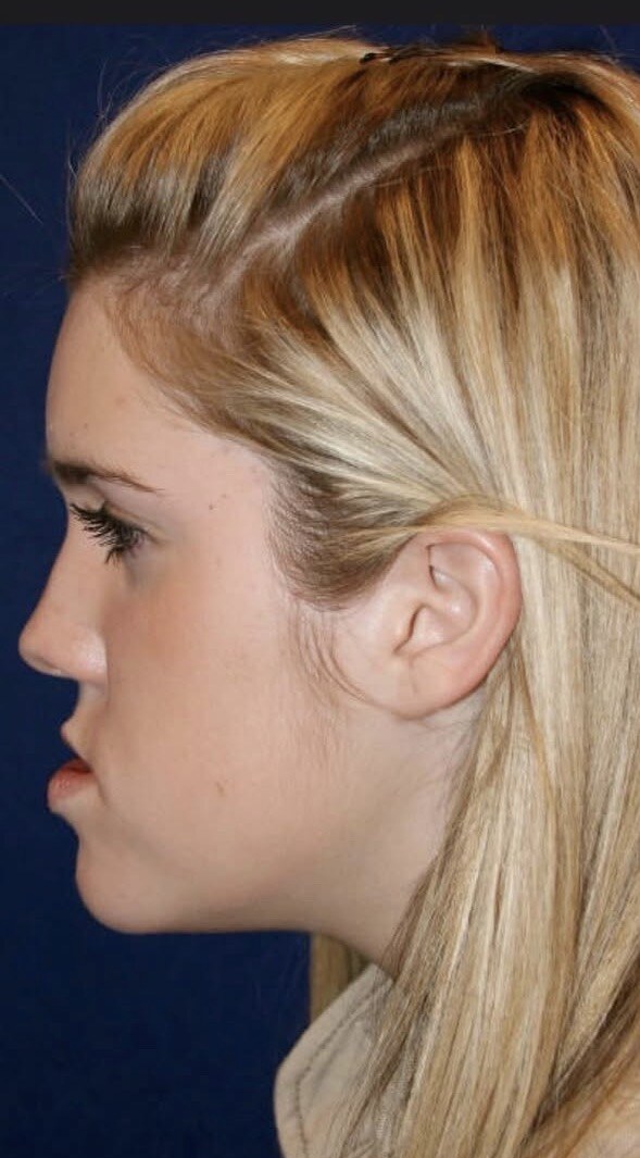 Before jaw surgery side profile photograph, West Palm Beach area patient