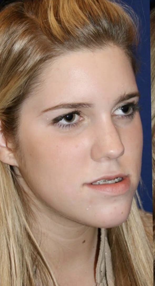 Before jaw surgery three-quarter view photograph, West Palm Beach area patient
