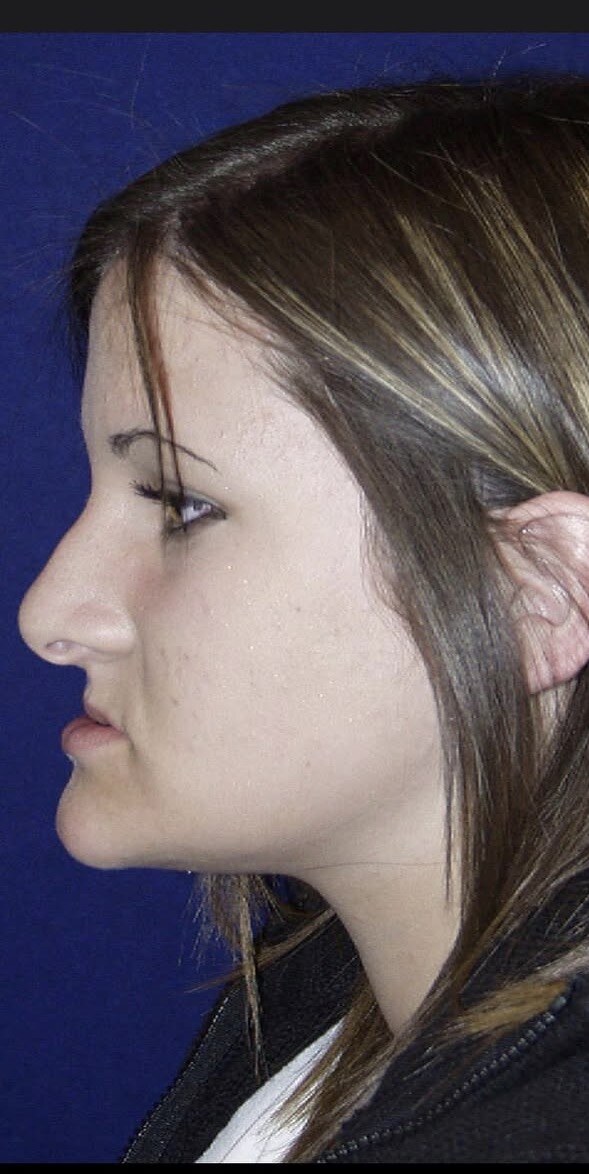 Before jaw surgery side profile photograph, West Palm Beach area patient