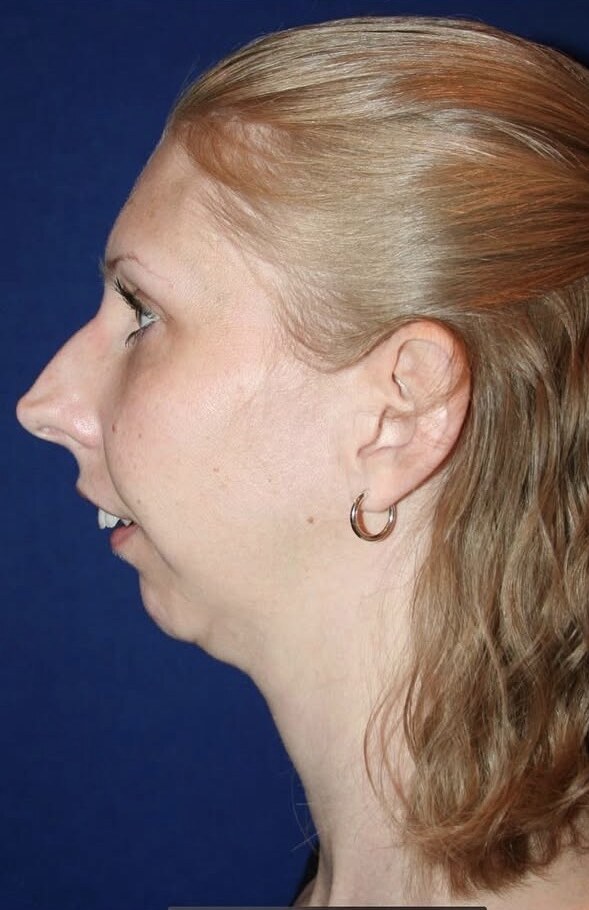 Before jaw surgery side profile photograph, West Palm Beach area patient