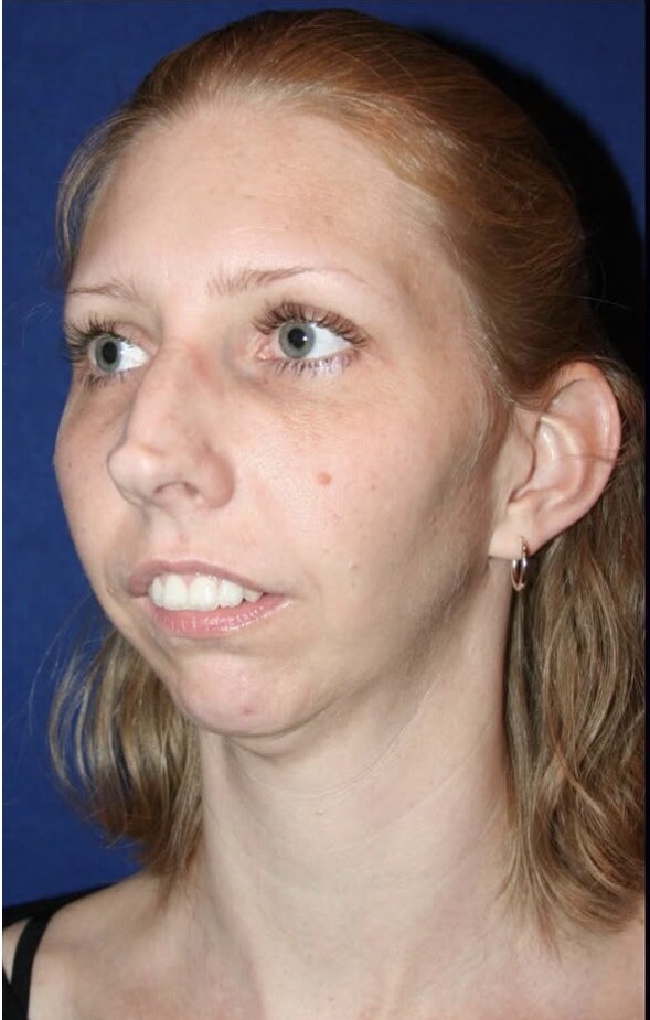 Before jaw surgery front oblique view photograph, West Palm Beach area patient