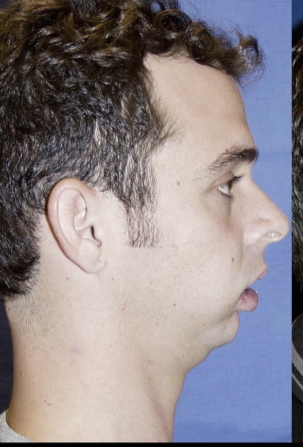 Before jaw surgery side profile photograph, West Palm Beach area patient