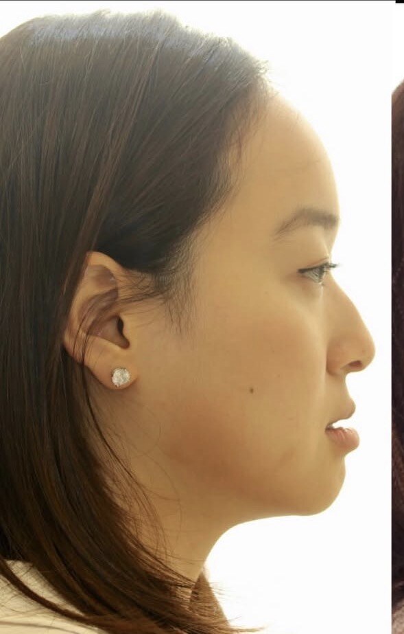 Before jaw surgery side profile photograph, West Palm Beach area patient