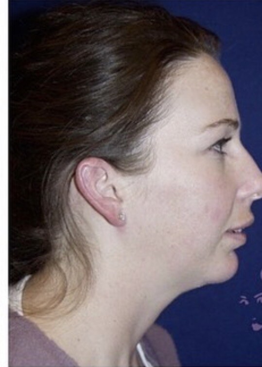 Before jaw surgery side profile photograph, West Palm Beach area patient