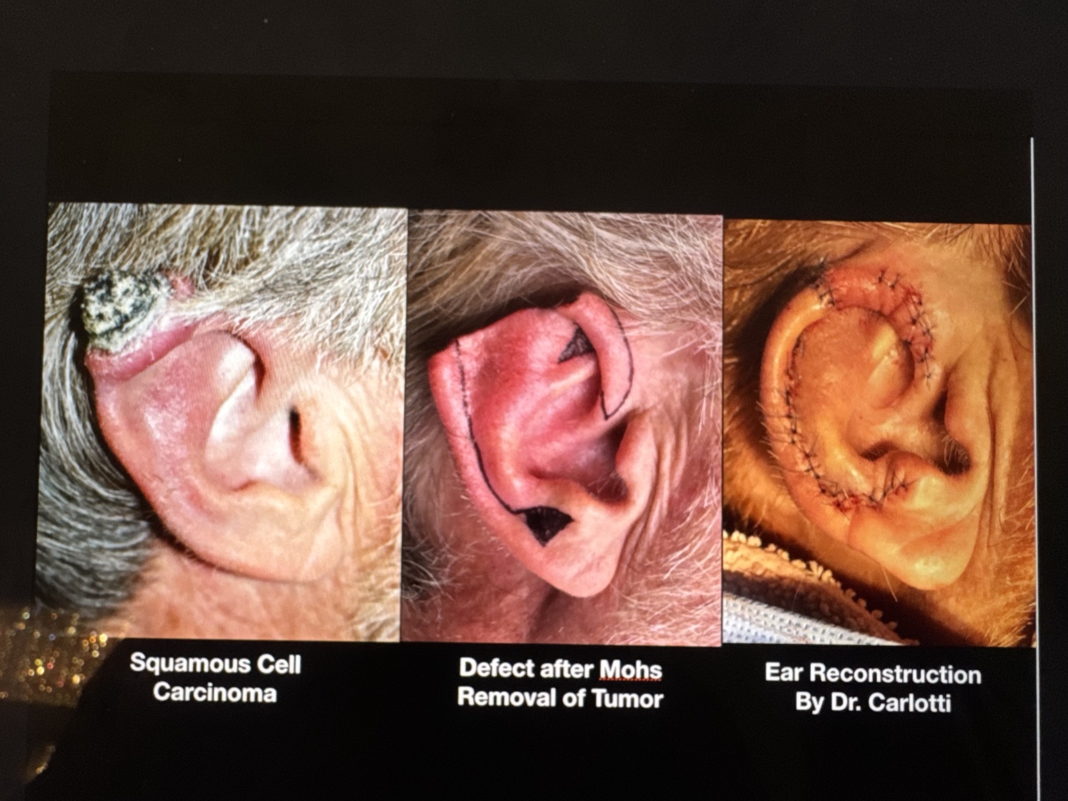 Ear reconstruction sequence showing squamous cell carcinoma, the defect after Mohs tumor removal, and reconstruction by Dr. Carlotti