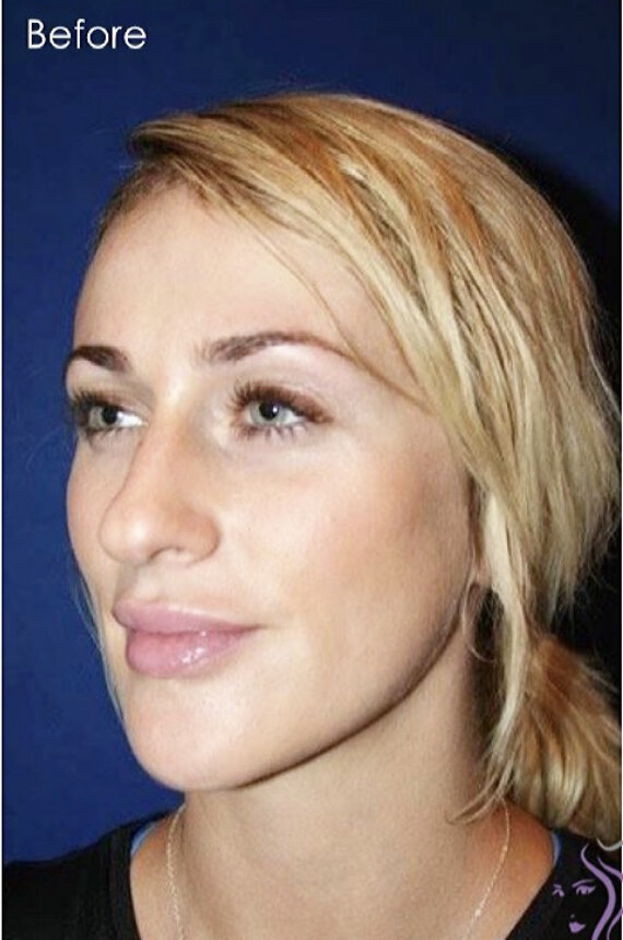 Before rhinoplasty three-quarter view photograph, West Palm Beach area patient