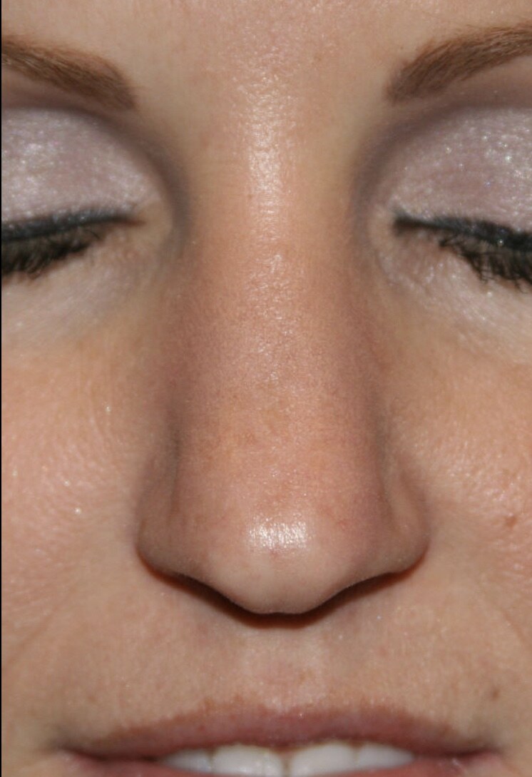 Before rhinoplasty frontal nasal close-up photograph, West Palm Beach area patient