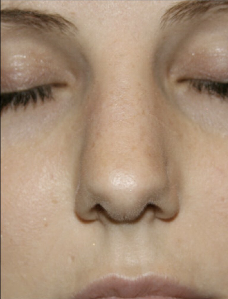 Before rhinoplasty frontal nasal close-up photograph, West Palm Beach area patient