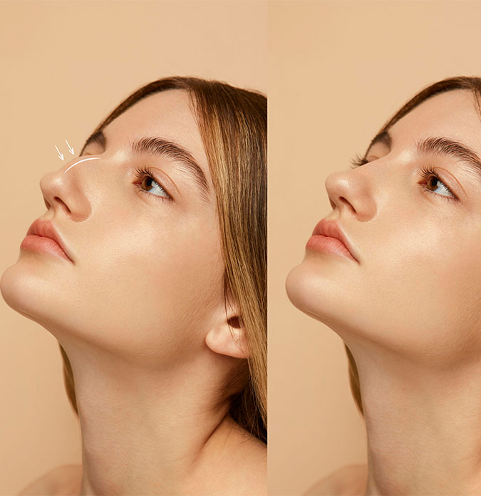 Rhinoplasty Surgical Approach