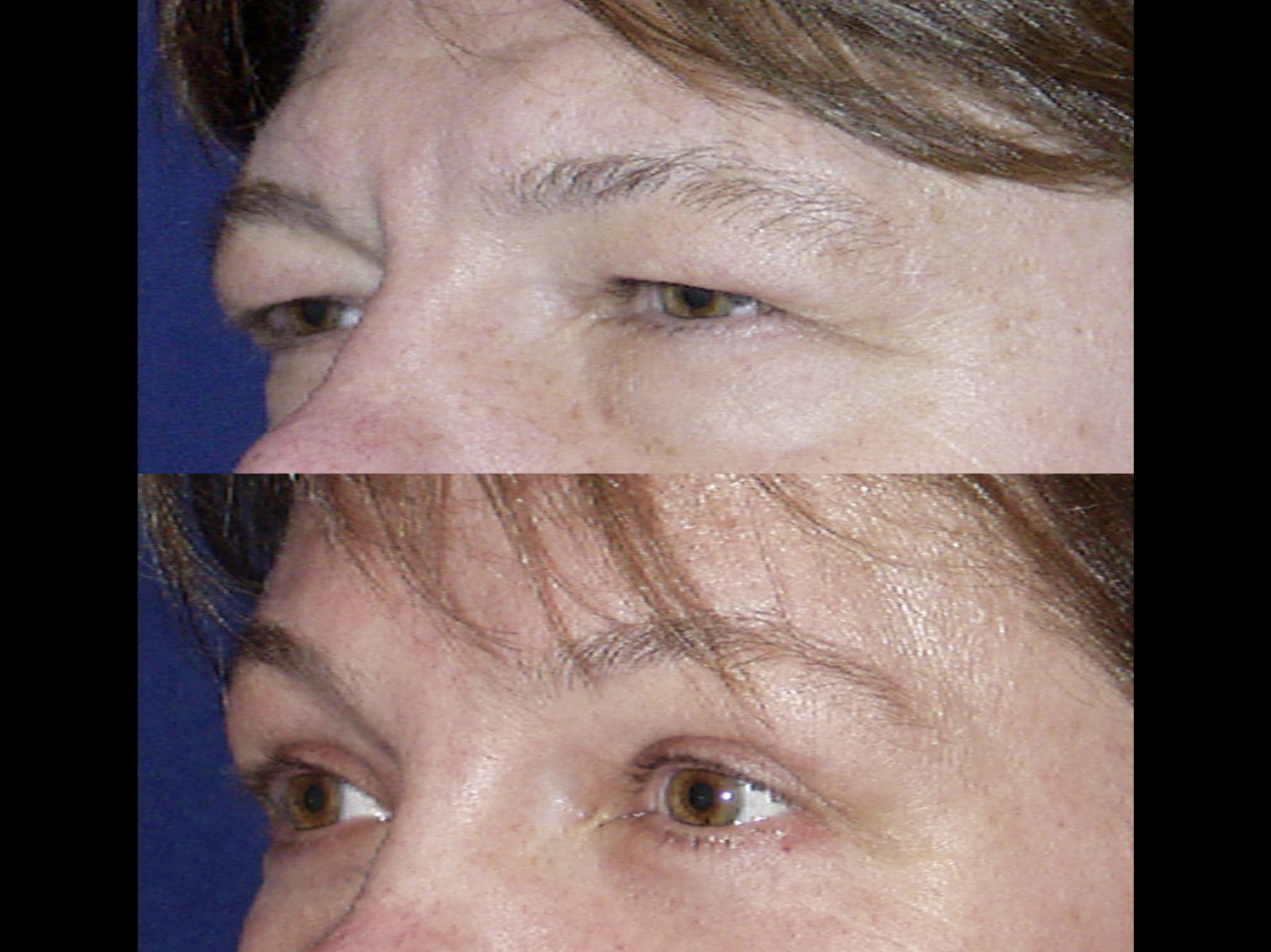 Brow lift patient result 1