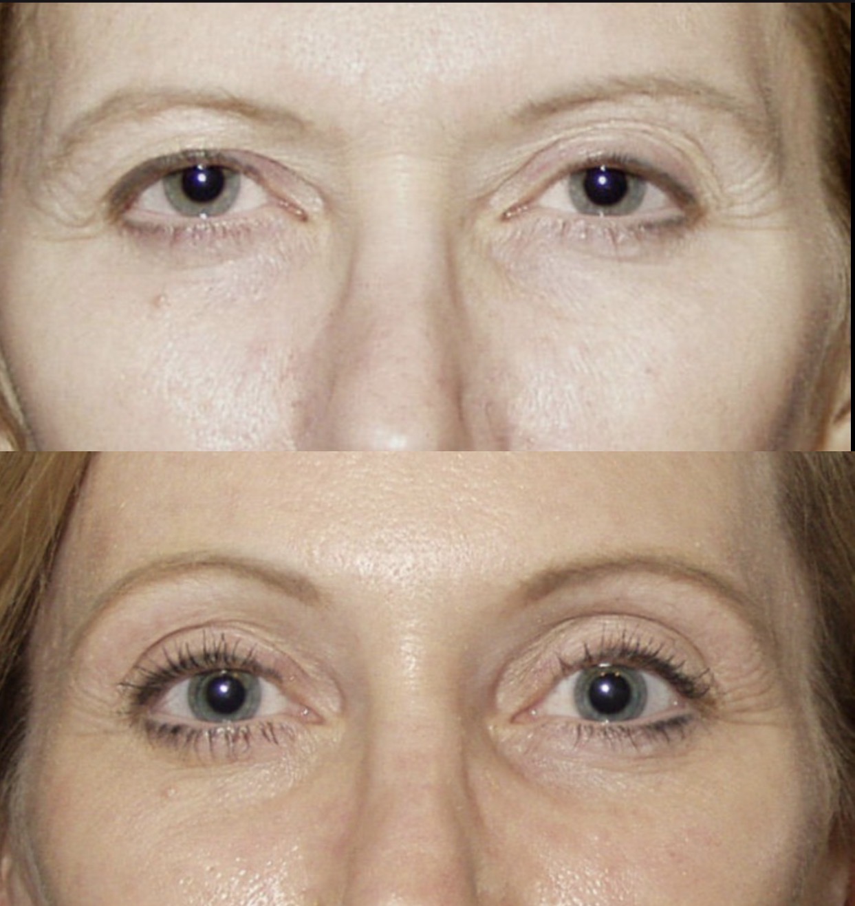 Brow lift patient result 2