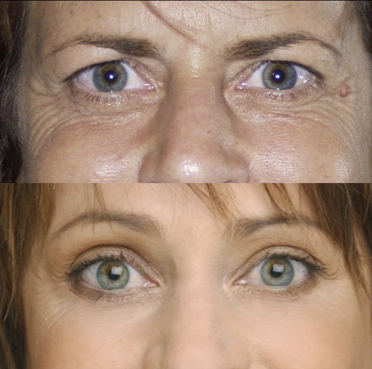 Brow lift patient result 3