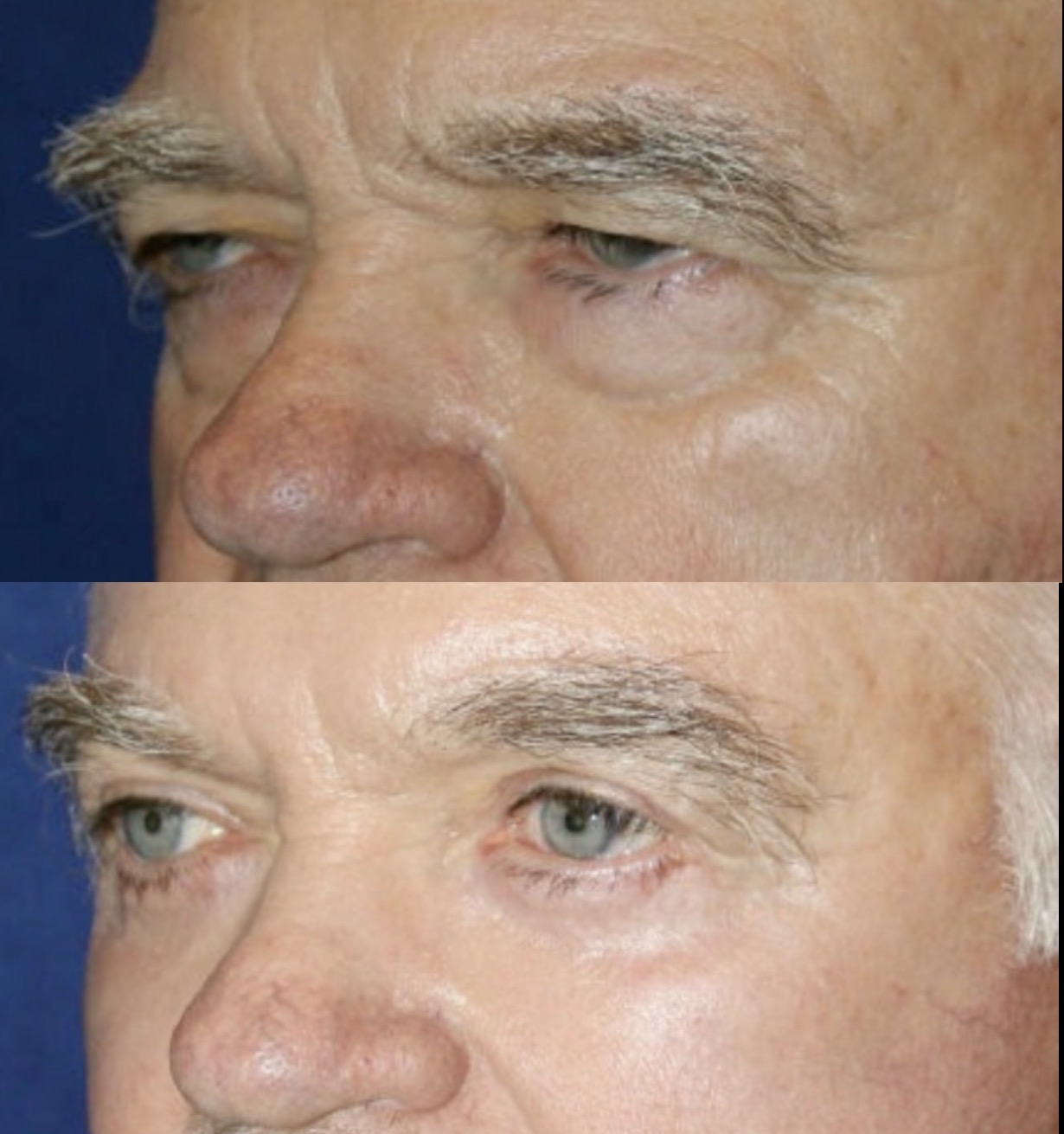 Brow lift patient result 4