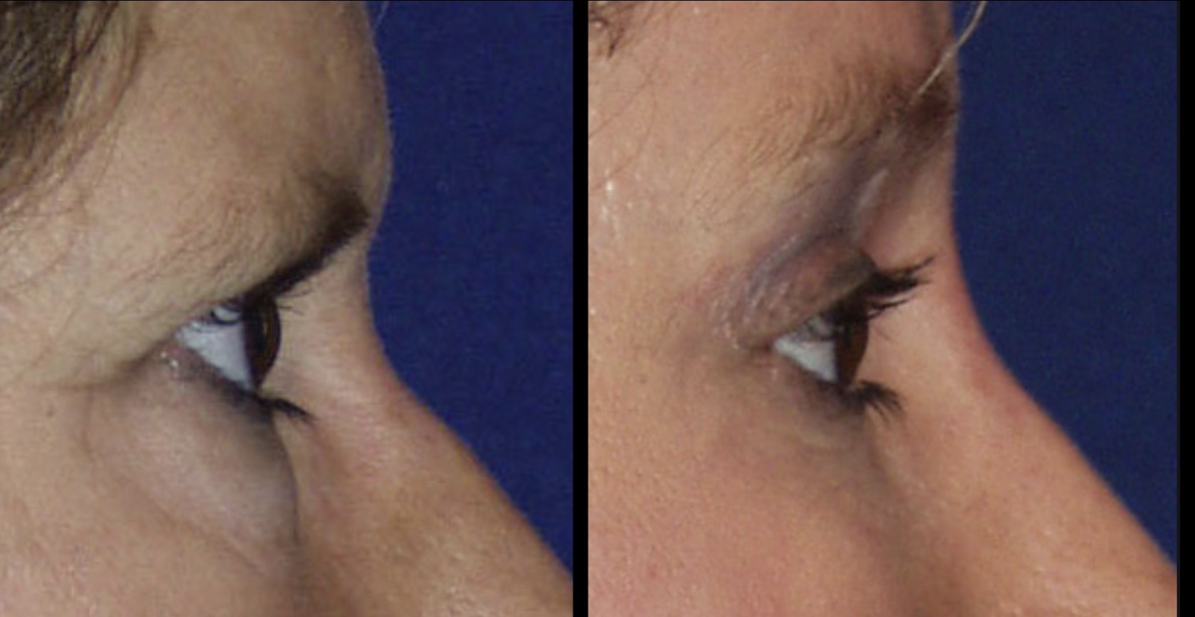 Brow lift patient result 5