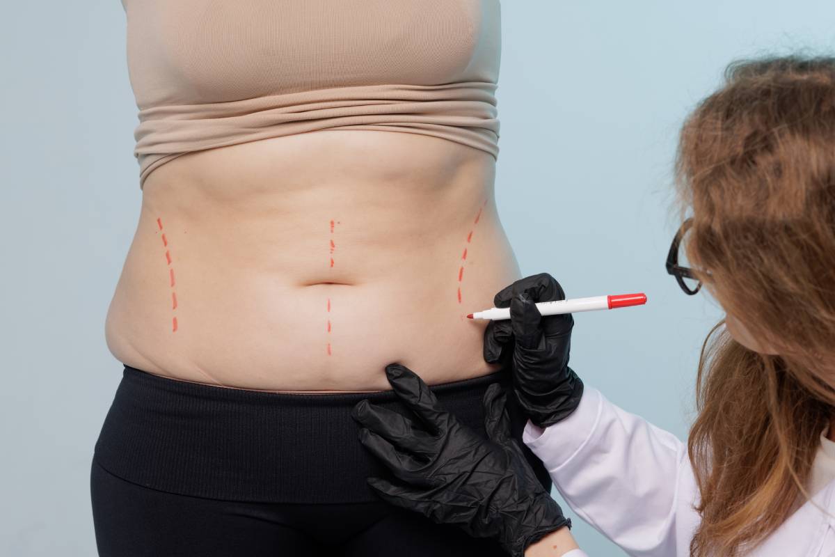 Liposuction Consultation