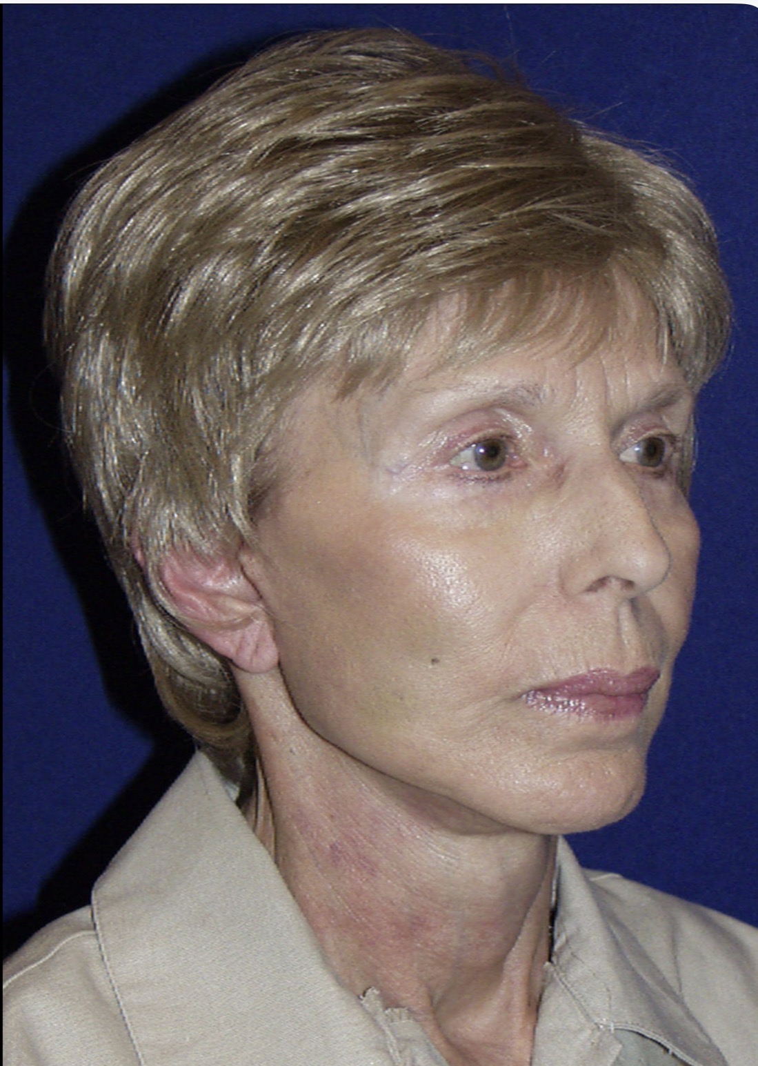 67-year-old woman 3 months after 4D Facelift, lower eyelid surgery, jaw angle implants and CO₂ laser resurfacing, oblique view.
