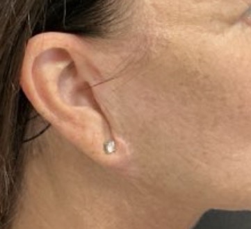 Batwing deformity near the ear, from Dr. Carlotti's teaching collection.