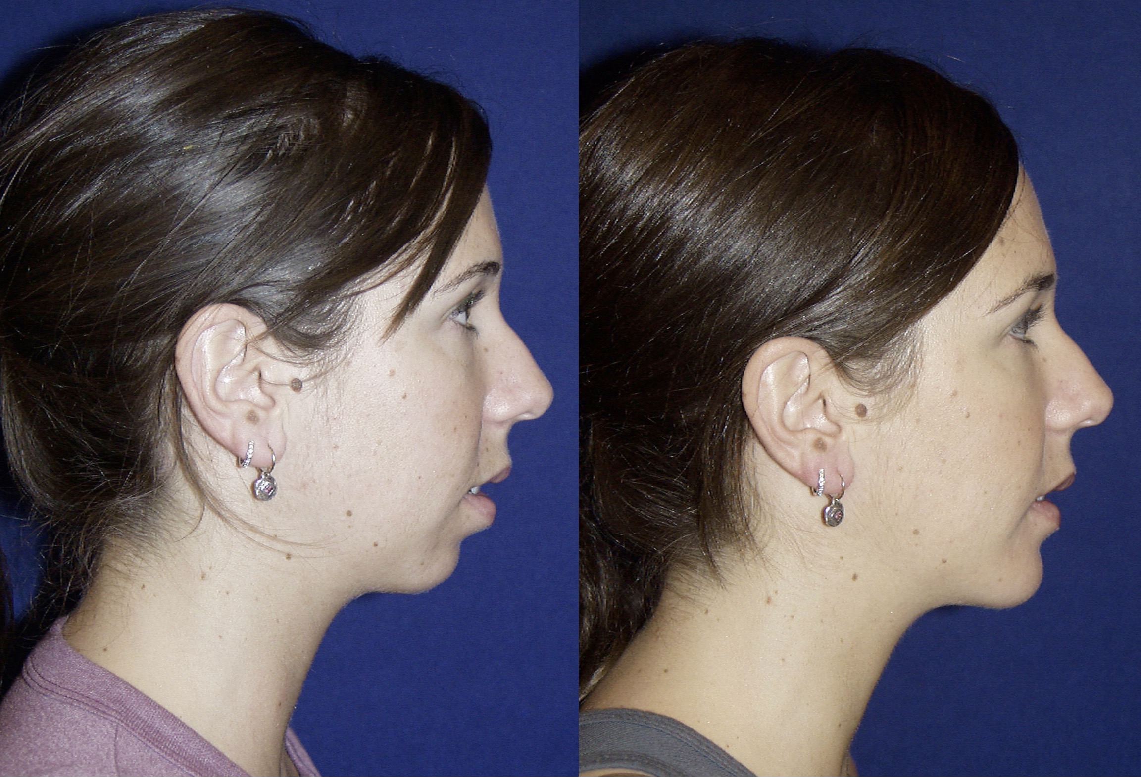 Before (left) and after (right) profile photographs supplied by Dr. Carlotti. Individual results vary.