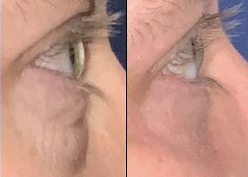 Before and after lower blepharoplasty by Dr. Albert Carlotti, side-view close-ups of the lower eyelid. Individual results vary.