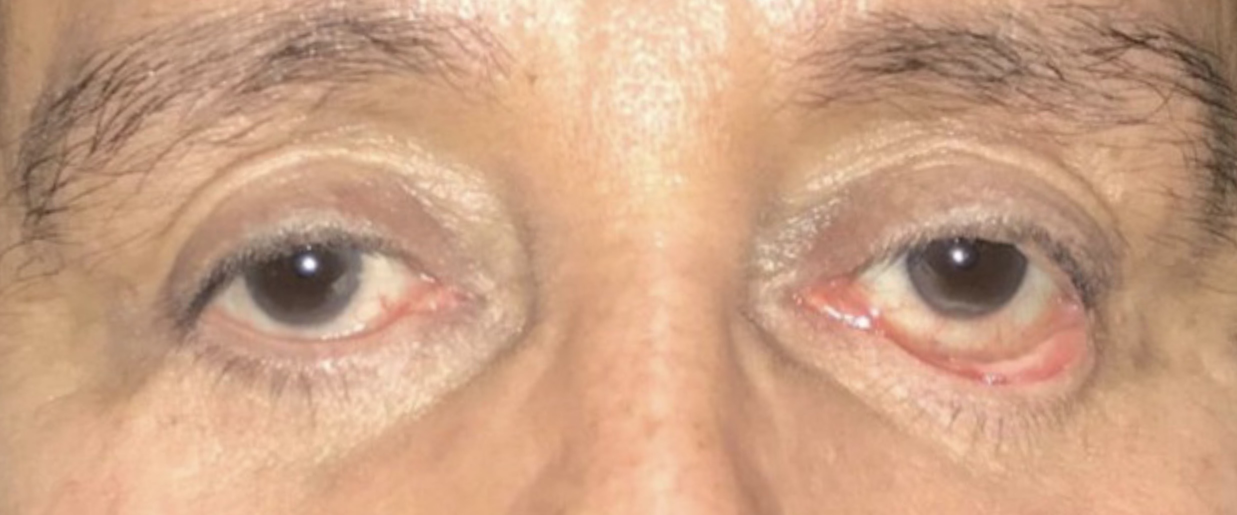 Lower lid retraction with visible white below the iris (scleral show) following surgery performed elsewhere