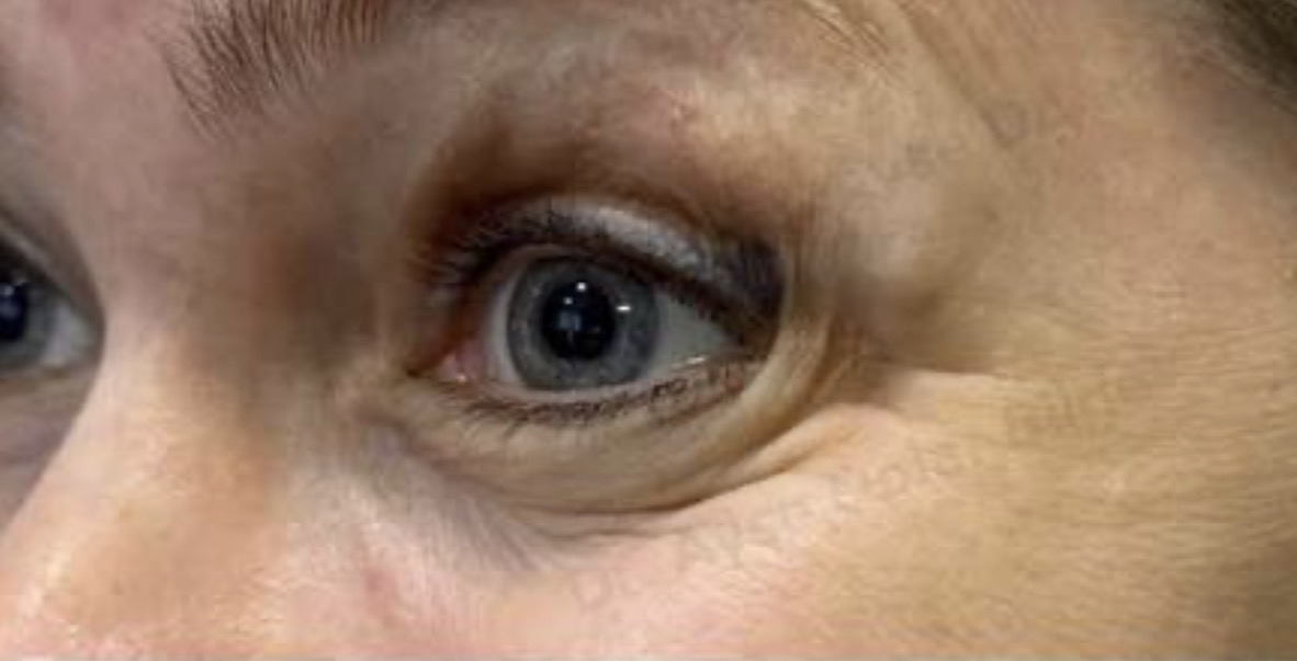 Webbed, blunted outer corner after lower blepharoplasty with canthal tightening following surgery performed elsewhere