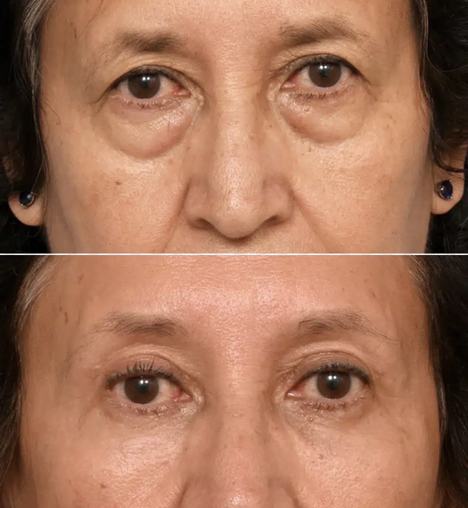 Shortened lower lid and altered eye shape compared with the patient’s natural appearance following surgery performed elsewhere