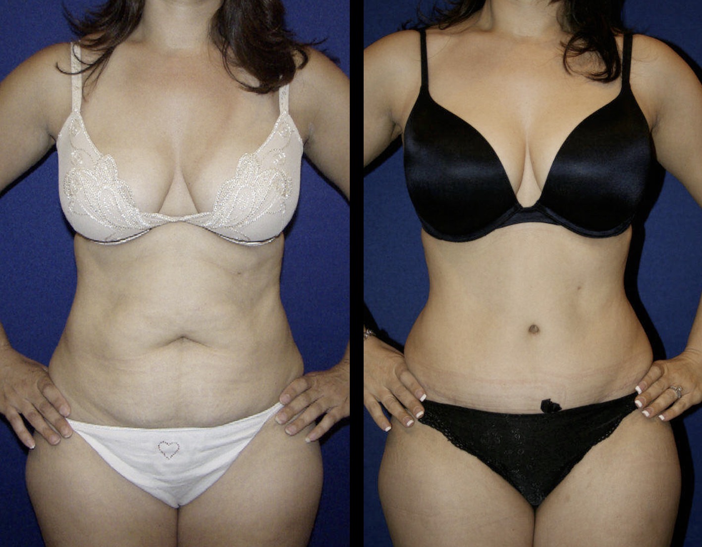 Before (left) and after (right) tummy tuck photographs supplied by Dr. Carlotti. Individual results vary.