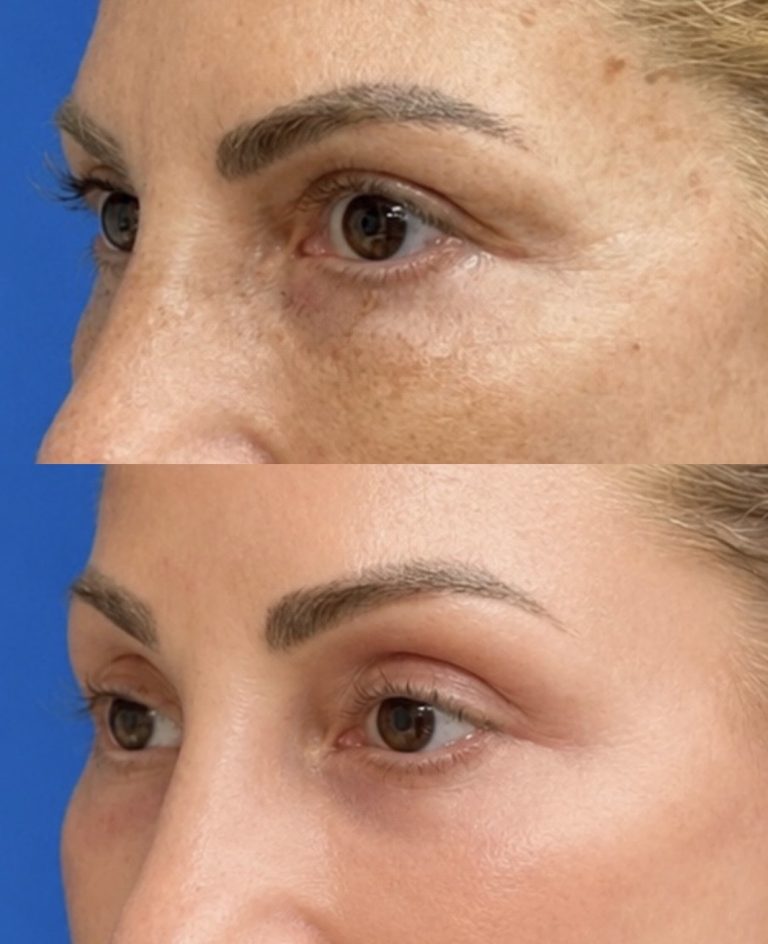 Before and three months after endoscopic brow lift with CO₂ laser, without blepharoplasty. Oblique view.