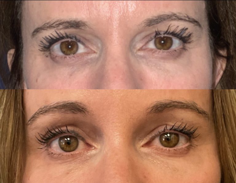 Before and three months after endoscopic brow lift without blepharoplasty. Front view.